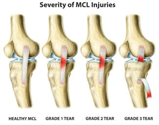 O que é a Lesão do Ligamento Colateral Medial LCM