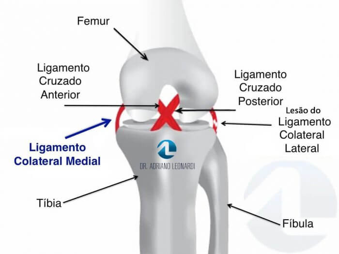 O que é a Lesão do Ligamento Colateral Medial LCM