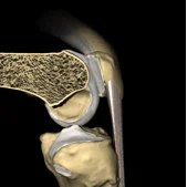 condromalácia patelar