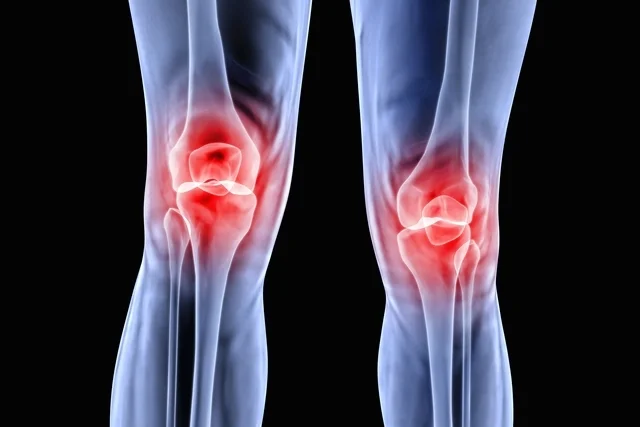 condromalacia patelar