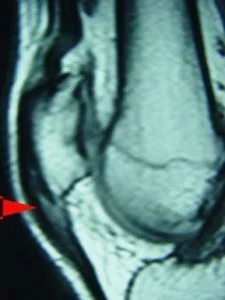 tendinite patelar joelho