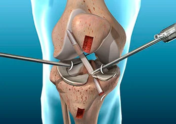 Reconstrucao Ligamento Cruzado Anterior Artroscopia