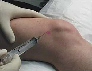 viscossuplementação do joelho