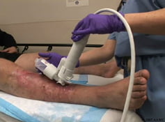 sintomas de dvt no músculo da panturrilha