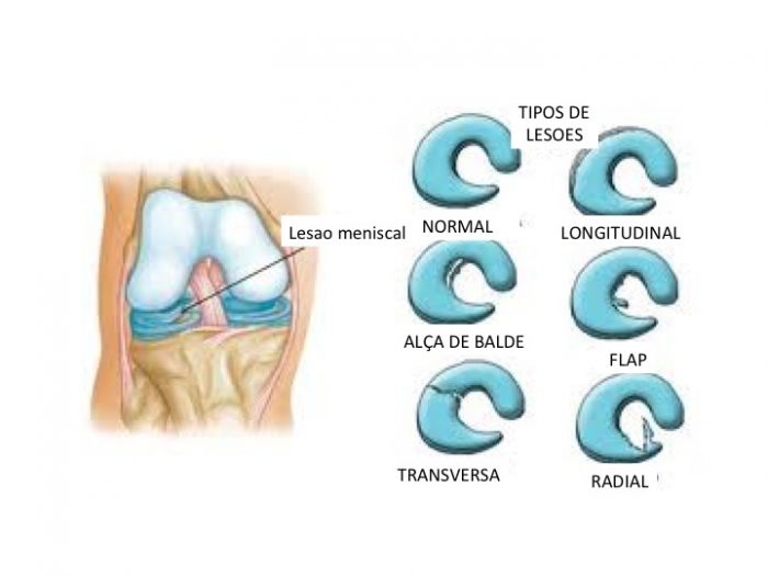 Lesões Meniscais Especialista do Joelho Dr Adriano Leonardi