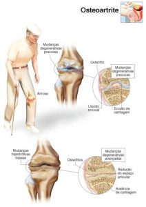 osteoartrite degenerativa do joelho