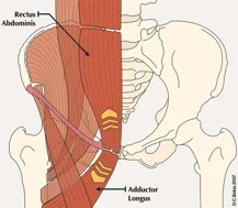 Hérnia inguinal nos praticantes de musculação - Hernia Clinic