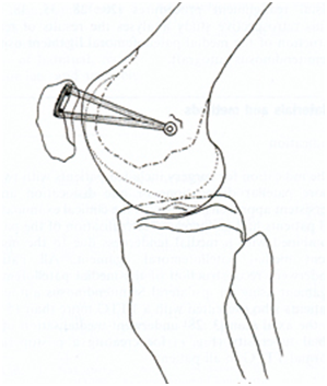 instabilidade femoropatelar joelho