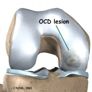 osteocondrite dissecante