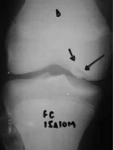 osteocondrite dissecante