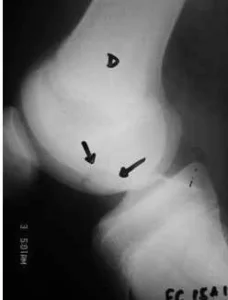 osteocondrite dissecante