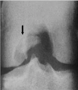 osteocondrite dissecante