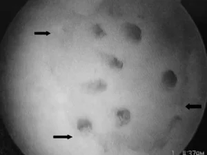 osteocondrite dissecante