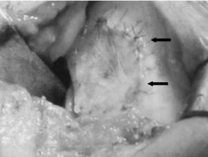 osteocondrite dissecante