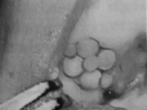 osteocondrite dissecante