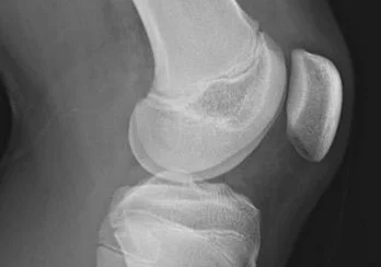 Sindrome Osgood Schlatter