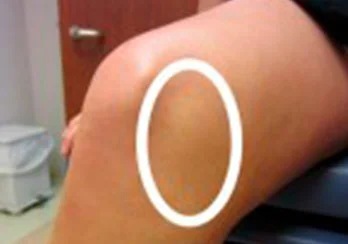 lesao ligamento colateral medial