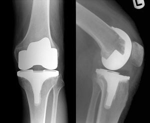 cirurgia prótese total do joelho