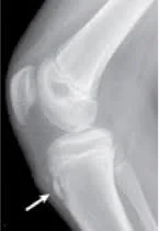 Sequelas Síndrome Osgood Schlatter
