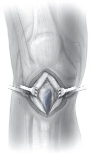 Sequelas Síndrome Osgood Schlatter