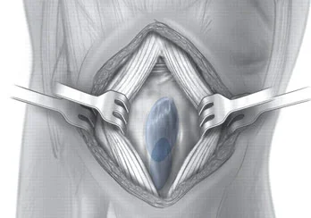 Sequelas Sindrome Osgood Schlatter