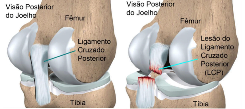 ligamento cruzado posterior