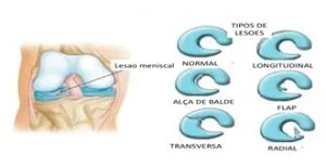 lesões meniscais