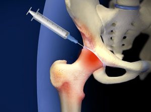 geluri și unguente pentru artroza articulației genunchiului