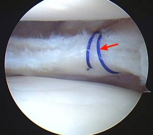 Foto retirada de uma artroscopia, onde a lesão do menisco foi suturada (costurada).