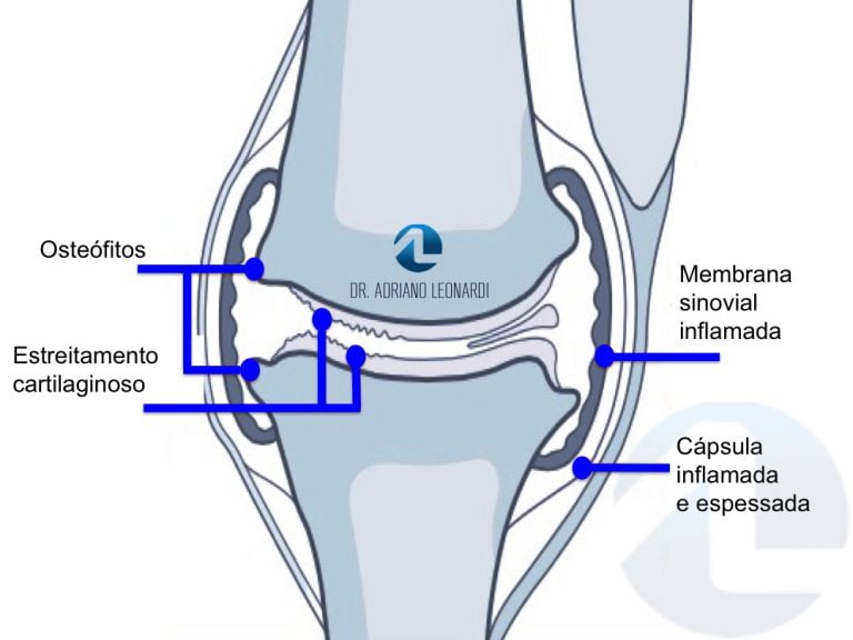 O Que Artrose No Joelho Especialista Do Joelho Dr Adriano Leonardi