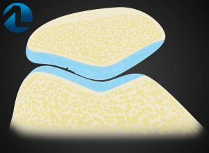 Diagnóstico da Condromalácia Patelar