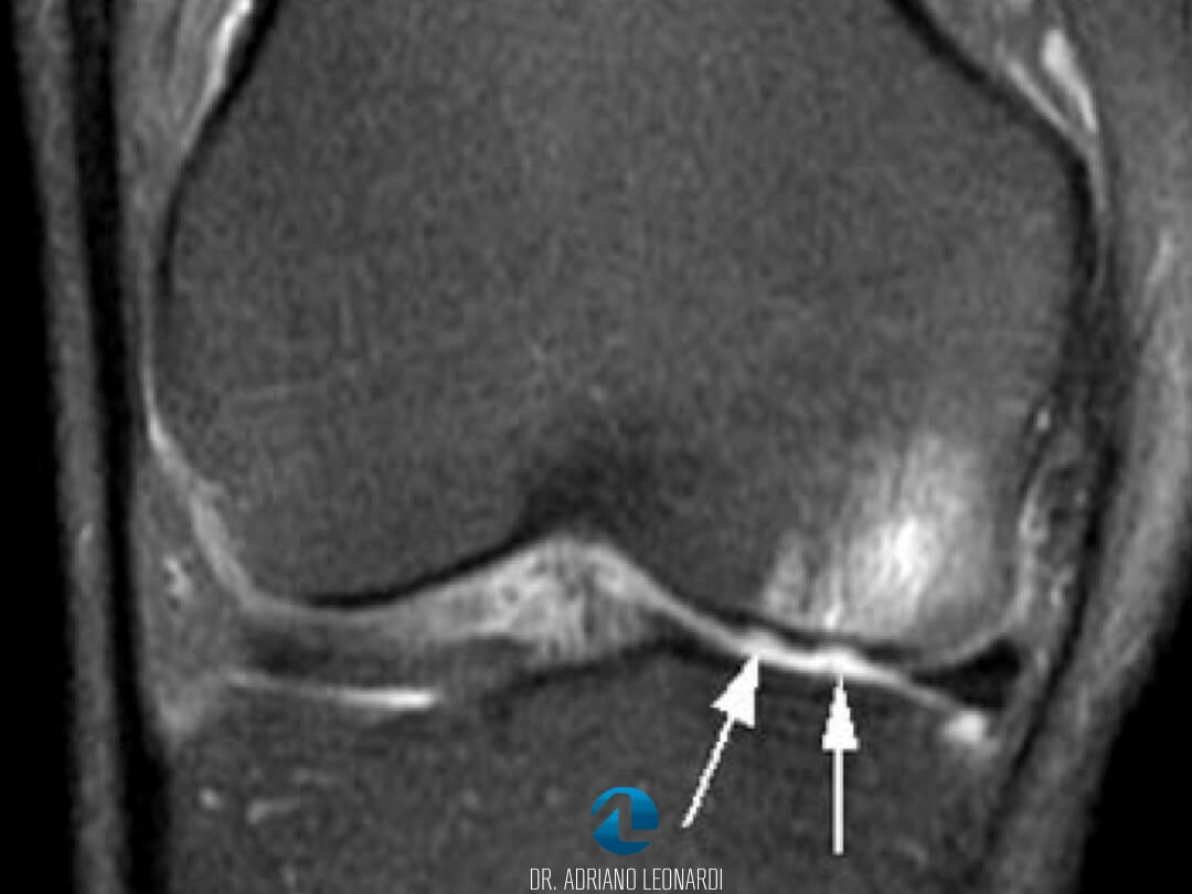 Diagnóstico da Lesão da Cartilagem do Joelho Especialista do Joelho