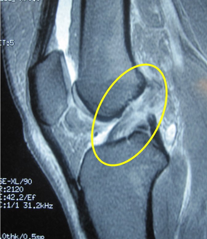 Resonância magnética para diagnóstico de ruptura do ligamento cruzado anterior.
