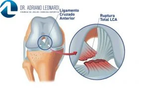 ligamento cruzado anterior lca 4