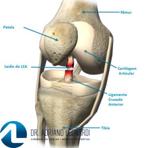 O Que Ligamento Cruzado Anterior Lca Especialista Do Joelho