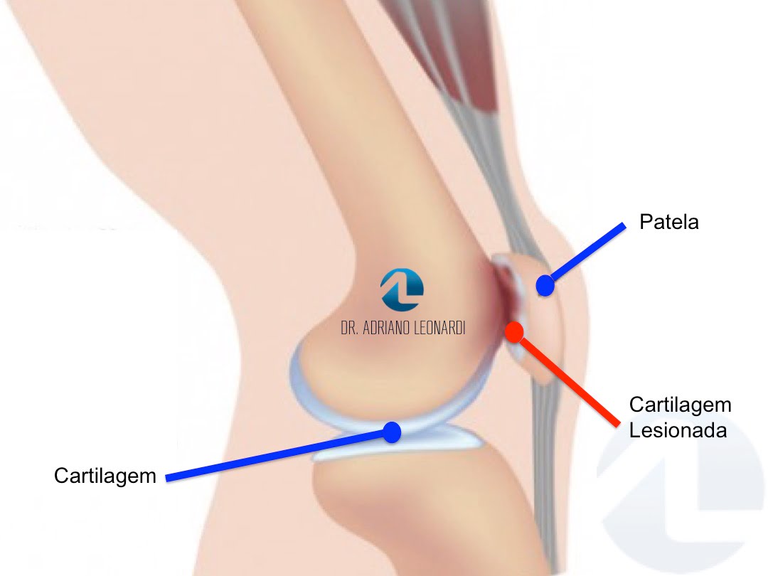 O Que é Condromalácia Patelar Especialista Do Joelho 0045