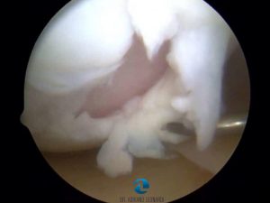 O que é Lesão na Cartilagem
