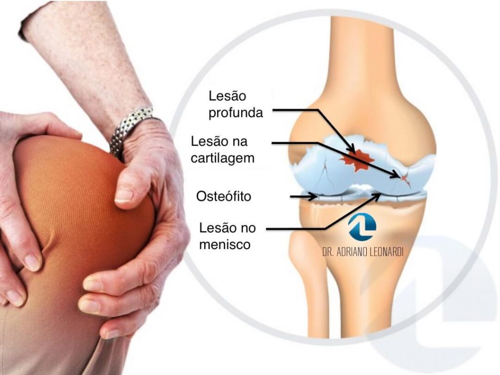 Ilustração de lesões na cartilagem do joelho.