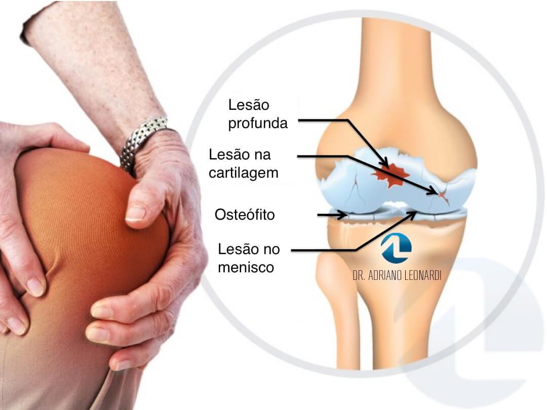 O Que é Lesão Da Cartilagem Do Joelho Especialista Do Joelho 6530