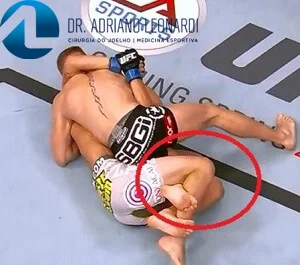Mecanismo que lesionam os meniscos como a luta.