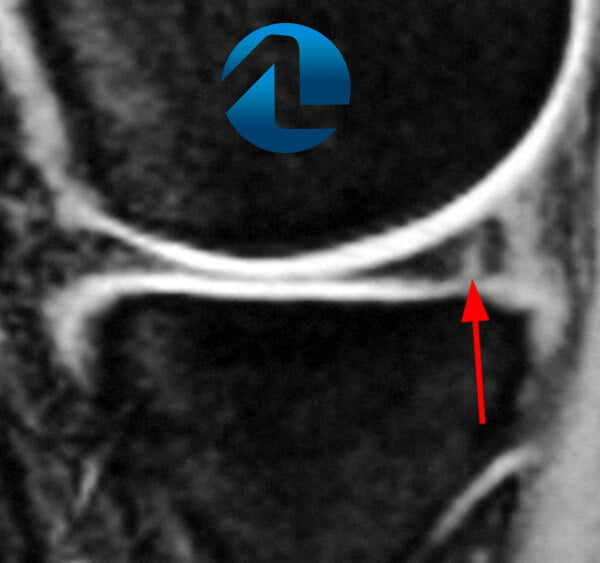 Ressonância magnética mostra uma lesão de menisco (setas).