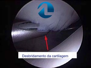Tratamento Cirúrgico da Condropatia