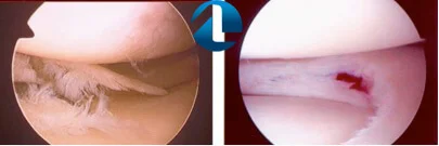 Tratamento cirúrgico lesão meniscal.
