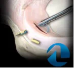 Tratamento cirúrgico lesão meniscal.