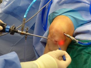 Tratamento Cirúrgico da Ruptura do Ligamento Cruzado Anterior