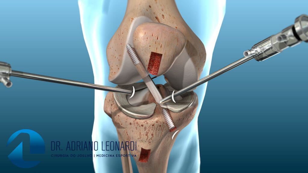 Tratamento cirúrgico ruptura de ligamento cruzado anterior.