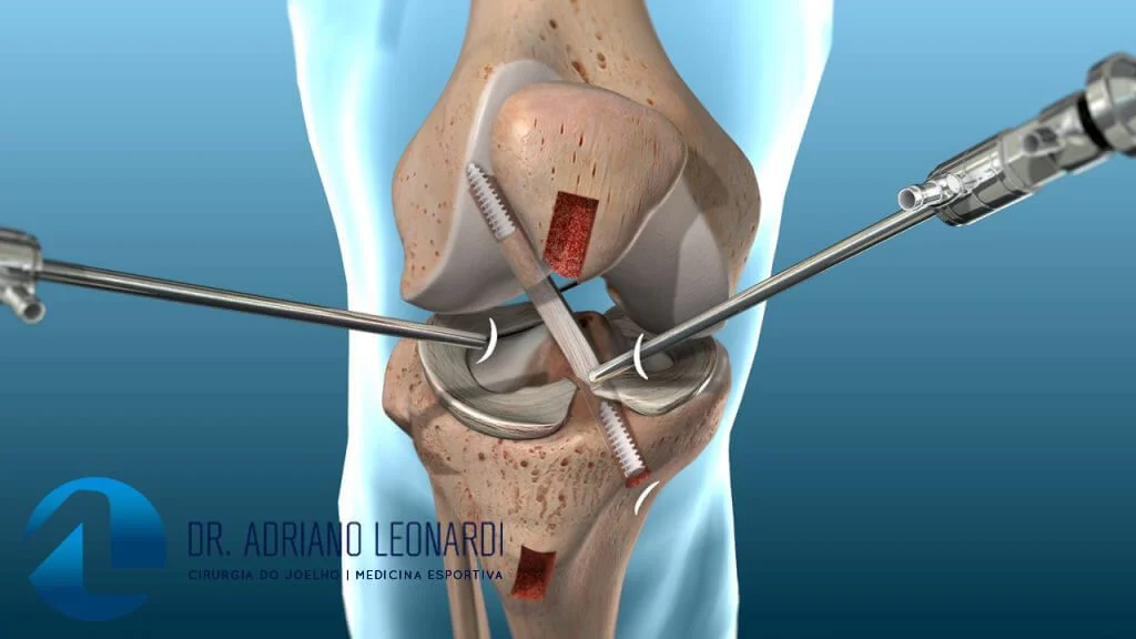 3 Formas de Fortalecer o Ligamento Colateral Medial (LCM)