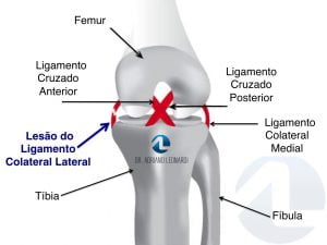 anatomia do joelho - ligamento colateral lateral