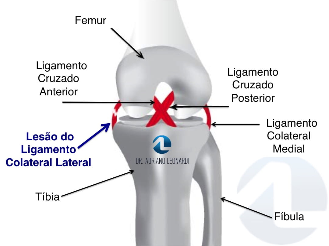 O Que A Les O Do Ligamento Colateral Lateral Lcl Especialista Do