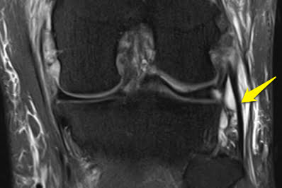 Radiográfia de lesão colateral lateral.